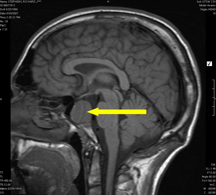 Pituitary tumor