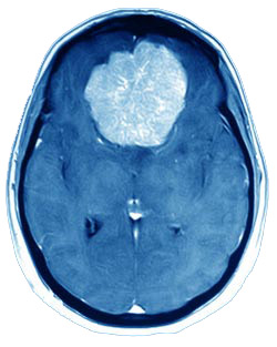 Meningioma