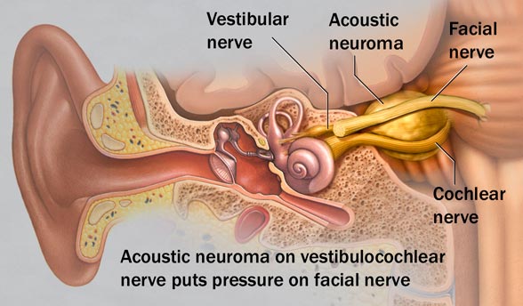 acoustic neuroma