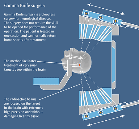 gamma knife surgery