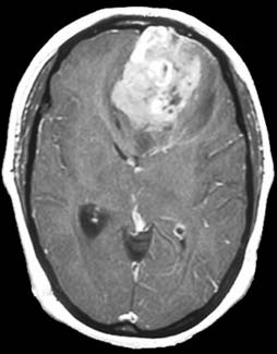 glioma