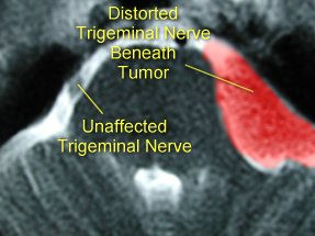 trigeminal neuralgia